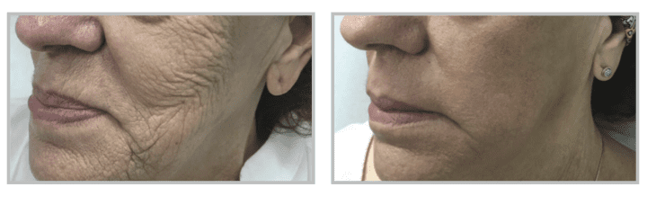 Sciton Contour TRL vs CO2 Laser