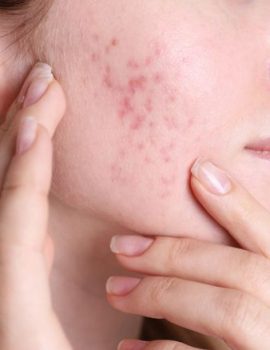 acne treatment manchester
