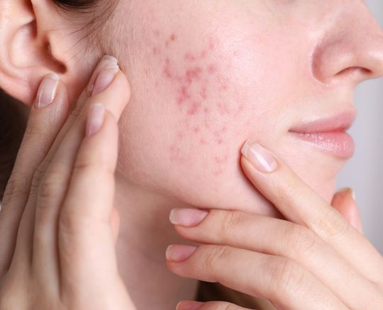 acne treatment manchester